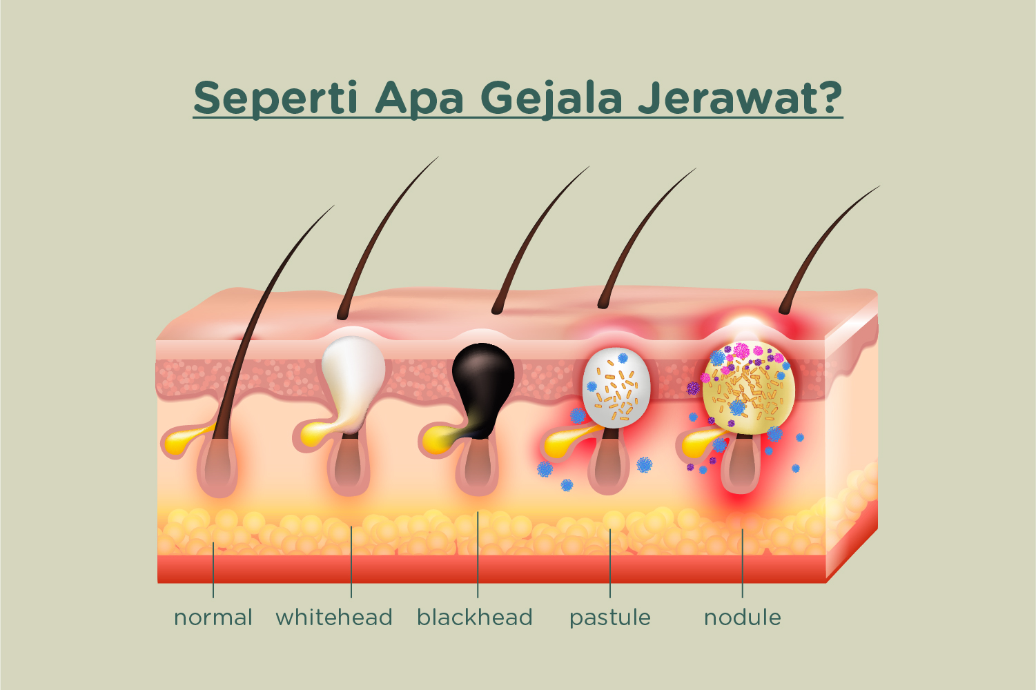 Seperti Apa Gejala Jerawat Surface